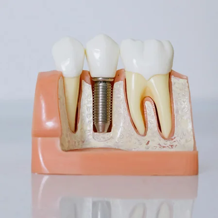 Dentist Encino CA Dental Implants BOX